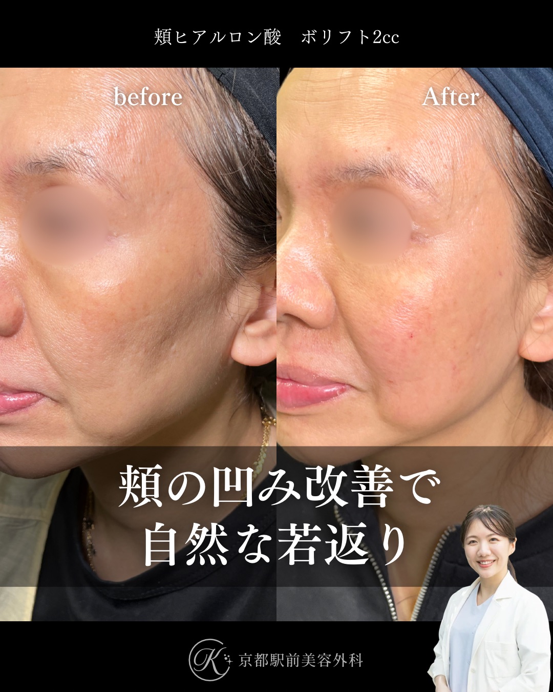 頬ヒアルロン酸の症例（京都駅前美容外科の症例写真）。頬コケを改善します。当院は滋賀、京都、大阪をはじめとした関西圏や全国から患者様にお越しいただいています。