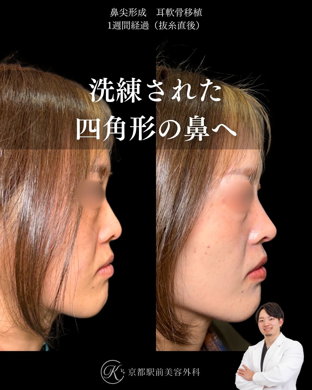 鼻尖形成・耳軟骨移植の１ヶ月後写真（京都駅前美容外科の鼻整形症例）当院は滋賀、京都、大阪をはじめとした関西圏や全国から患者様にお越しいただいています。