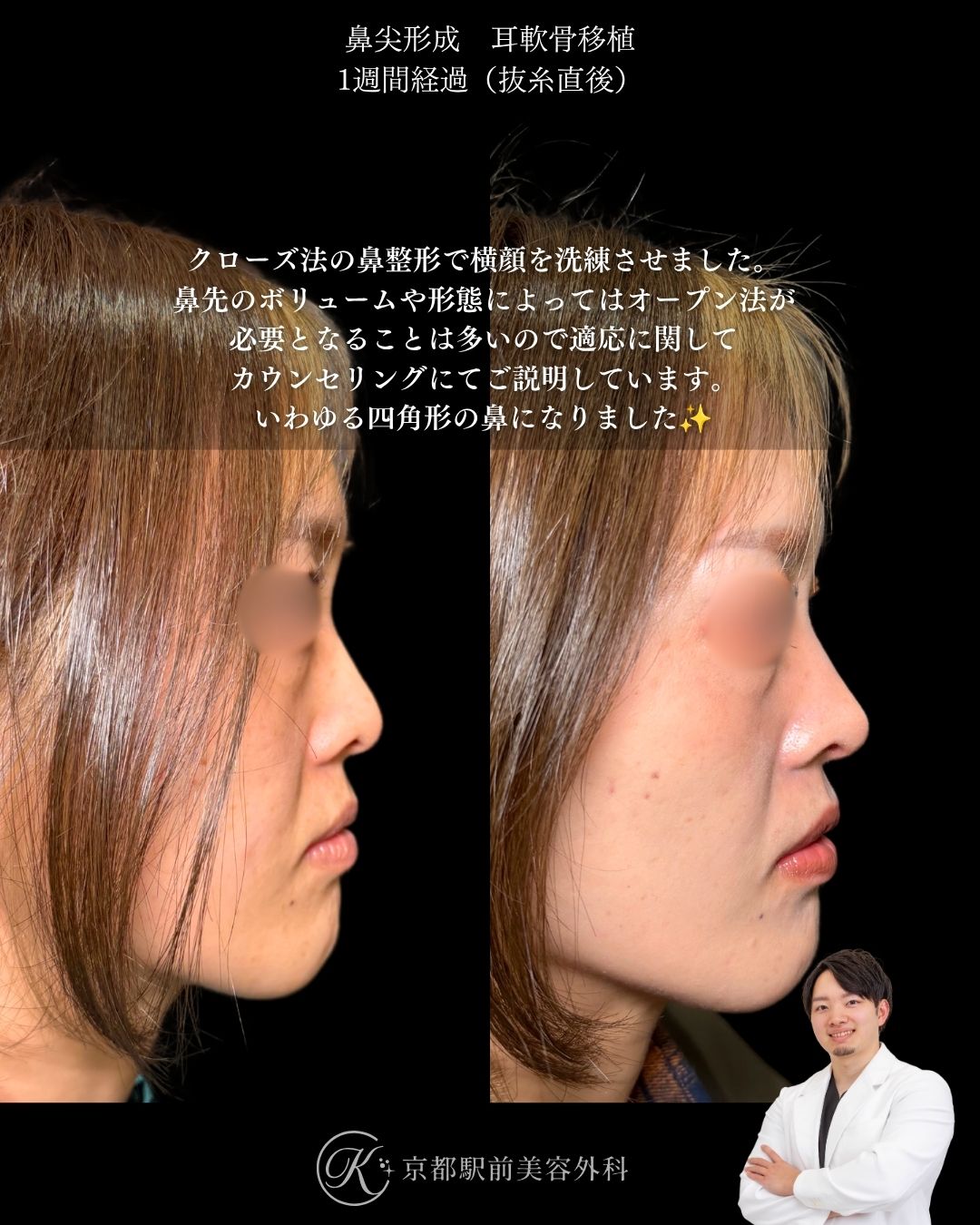 鼻尖形成・耳軟骨移植の１ヶ月後写真（京都駅前美容外科の鼻整形症例）当院は滋賀、京都、大阪をはじめとした関西圏や全国から患者様にお越しいただいています。