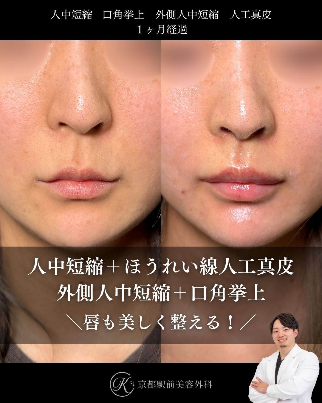 人中短縮、口角挙上、外側人中短縮、人工真皮の術後経過。京都駅前美容外科の症例画像。当院は滋賀、京都、大阪をはじめとした関西圏や全国から患者様にお越しいただいています。