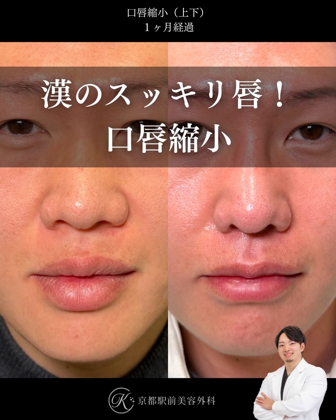 口唇縮小の術後経過写真（京都駅前美容外科の症例）当院は滋賀、京都、大阪をはじめとした関西圏や全国から患者様にお越しいただいています。
