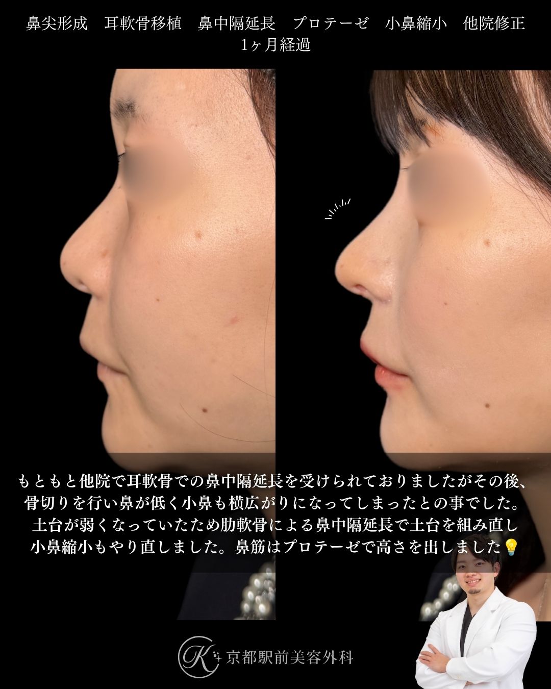 骨切りと他院鼻中隔延長術後の低くなった鼻を美しく戻す。鼻尖形成、耳軟骨移植、鼻中隔延長、プロテーゼ、小鼻縮小、他院修正など（京都駅前美容外科の症例）当院は滋賀、京都、大阪をはじめとした関西圏や全国から患者様にお越しいただいています。
