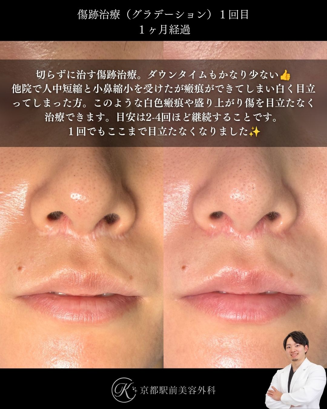 切らずに治す傷跡治療・傷跡修正（グラデーション治療）の症例画像。人中短縮と小鼻縮小によりできた傷跡の写真など（京都駅前美容外科の症例写真）当院は滋賀、京都、大阪をはじめとした関西圏や全国から患者様にお越しいただいています。