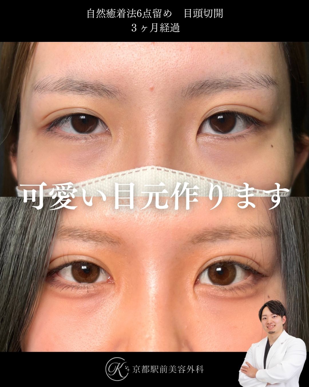 二重埋没法（自然癒着法法6点留め）＋目頭切開の３ヶ月経過写真（京都駅前美容外科の症例）当院は滋賀、京都、大阪をはじめとした関西圏や全国から患者様にお越しいただいています。