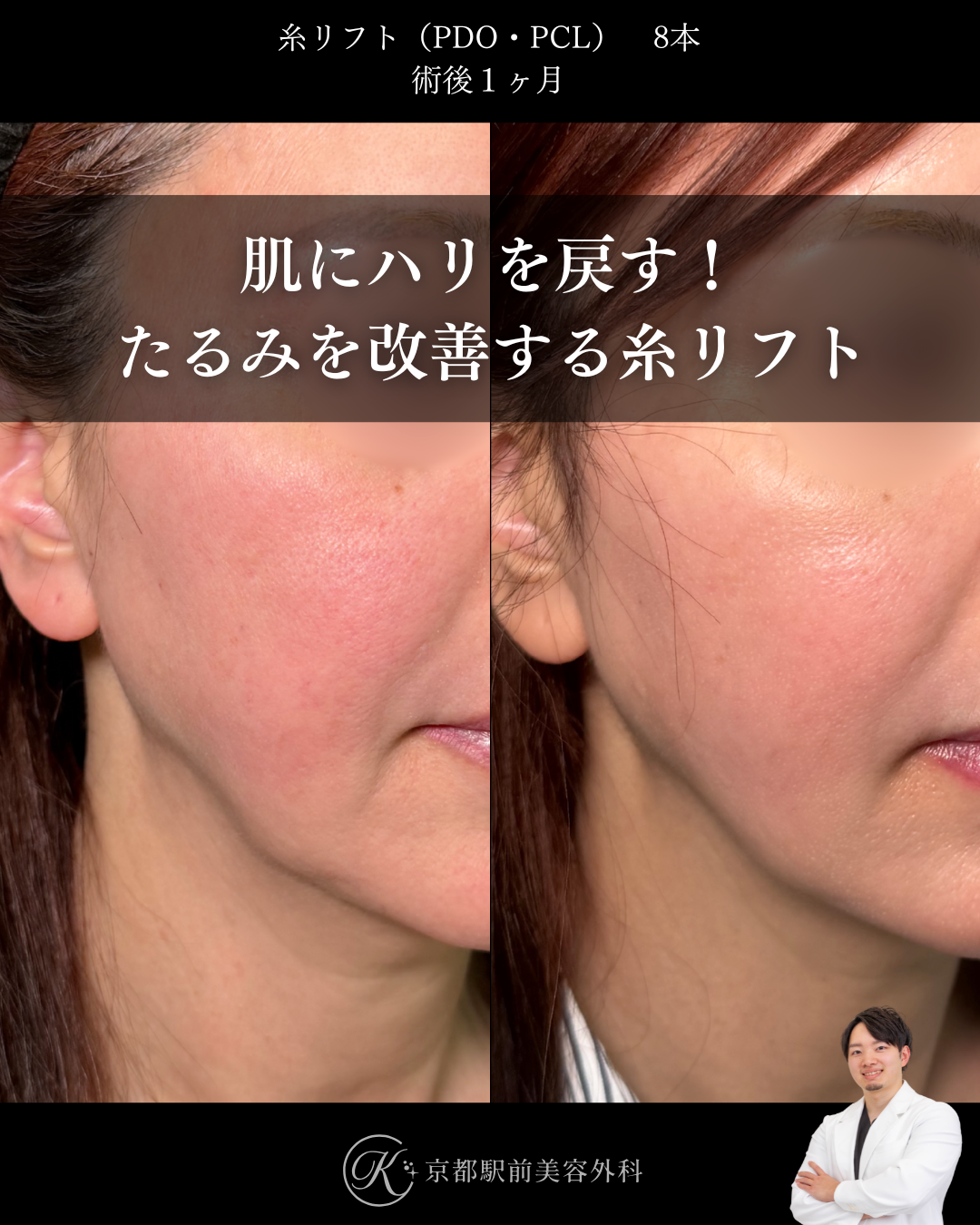 肌にハリを戻す！たるみを改善する糸リフト。京都駅前美容外科の症例画像。当院は滋賀、京都、大阪をはじめとした関西圏や全国から患者様にお越しいただいています。