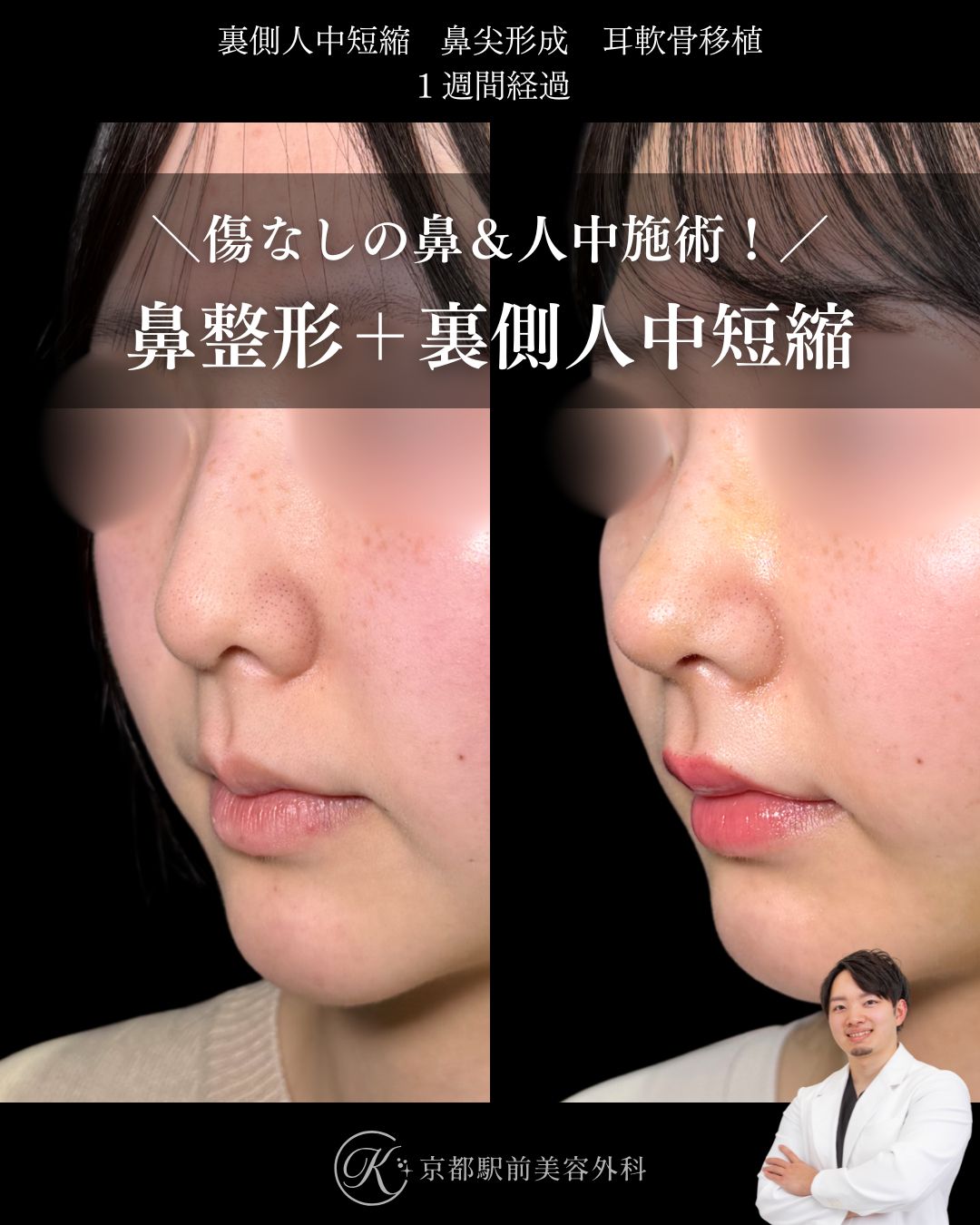 クローズ法の鼻尖形成、耳軟骨移植、裏側人中短縮の症例（京都駅前美容外科の症例写真）当院は滋賀、京都、大阪をはじめとした関西圏や全国から患者様にお越しいただいています。