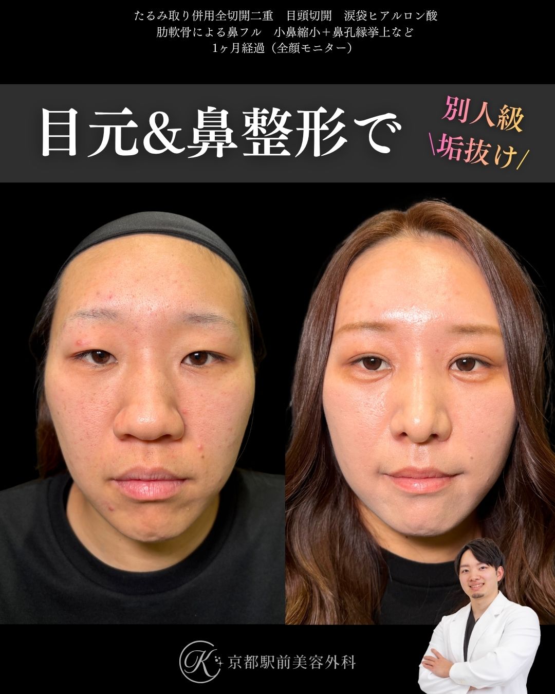 肋軟骨による鼻整形と目元整形（たるみ取り併用全切開と目頭切開と涙袋ヒアルロン酸）の術直後写真（京都駅前美容外科の鼻整形症例）当院は滋賀、京都、大阪をはじめとした関西圏や全国から患者様にお越しいただいています。