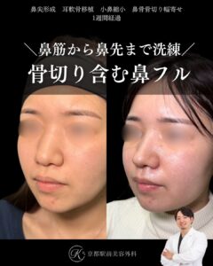 鼻筋から鼻先まで洗練、骨切り含む鼻整形。鼻尖形成・耳軟骨移植・小鼻縮小・鼻骨骨切り幅寄せの１ヶ月経過写真（京都駅前美容外科の鼻整形症例）当院は滋賀、京都、大阪をはじめとした関西圏や全国から患者様にお越しいただいています。