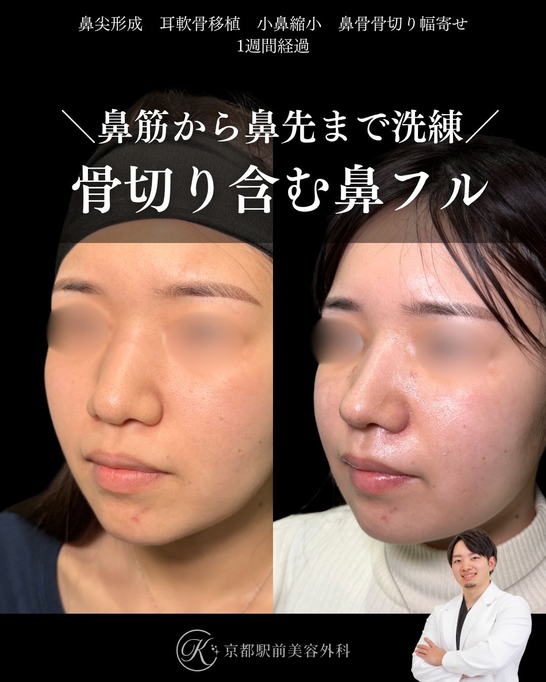 鼻筋から鼻先まで洗練、骨切り含む鼻整形。鼻尖形成・耳軟骨移植・小鼻縮小・鼻骨骨切り幅寄せの１ヶ月経過写真（京都駅前美容外科の鼻整形症例）当院は滋賀、京都、大阪をはじめとした関西圏や全国から患者様にお越しいただいています。