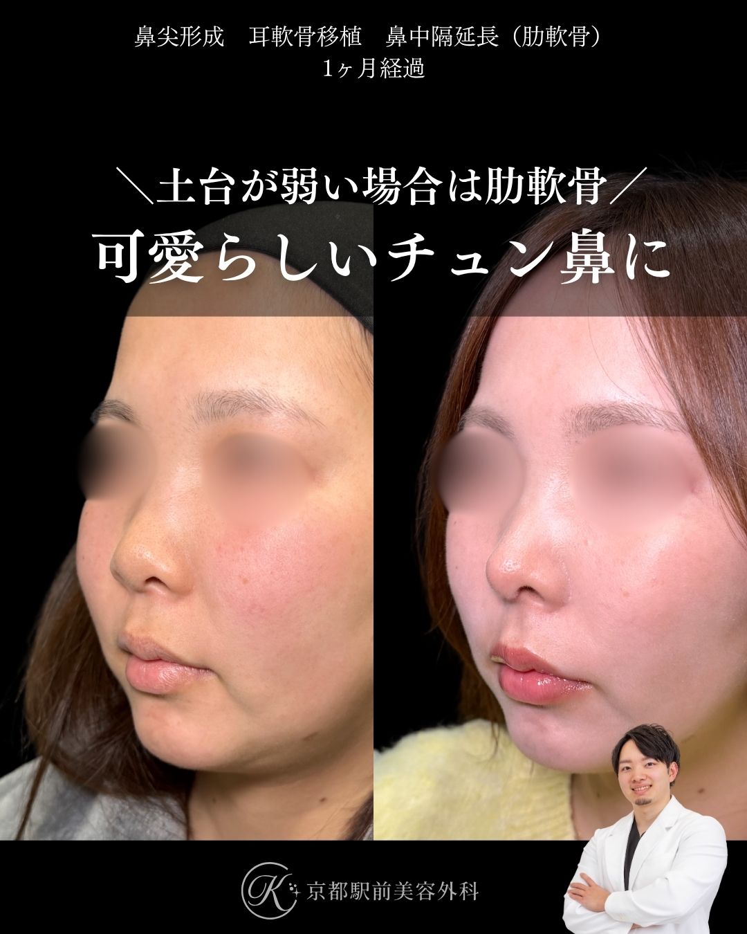 肋軟骨による鼻整形の症例写真（京都駅前美容外科の鼻整形症例）当院は滋賀、京都、大阪をはじめとした関西圏や全国から患者様にお越しいただいています。