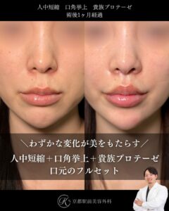 人中短縮、口角挙上、貴族プロテーゼの術後経過。京都駅前美容外科の症例画像。当院は滋賀、京都、大阪をはじめとした関西圏や全国から患者様にお越しいただいています。