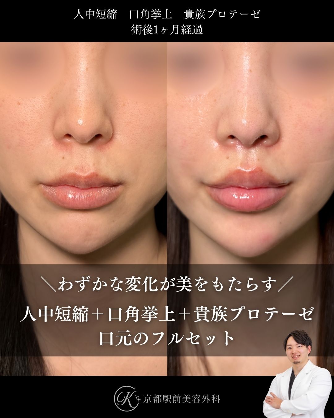 人中短縮、口角挙上、貴族プロテーゼの術後経過。京都駅前美容外科の症例画像。当院は滋賀、京都、大阪をはじめとした関西圏や全国から患者様にお越しいただいています。