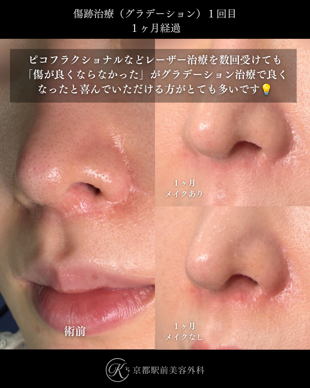傷跡治療・傷跡修正（グラデーション治療）の症例画像。人中短縮と小鼻縮小によりできた傷跡の写真など（京都駅前美容外科の症例写真）当院は滋賀、京都、大阪をはじめとした関西圏や全国から患者様にお越しいただいています。