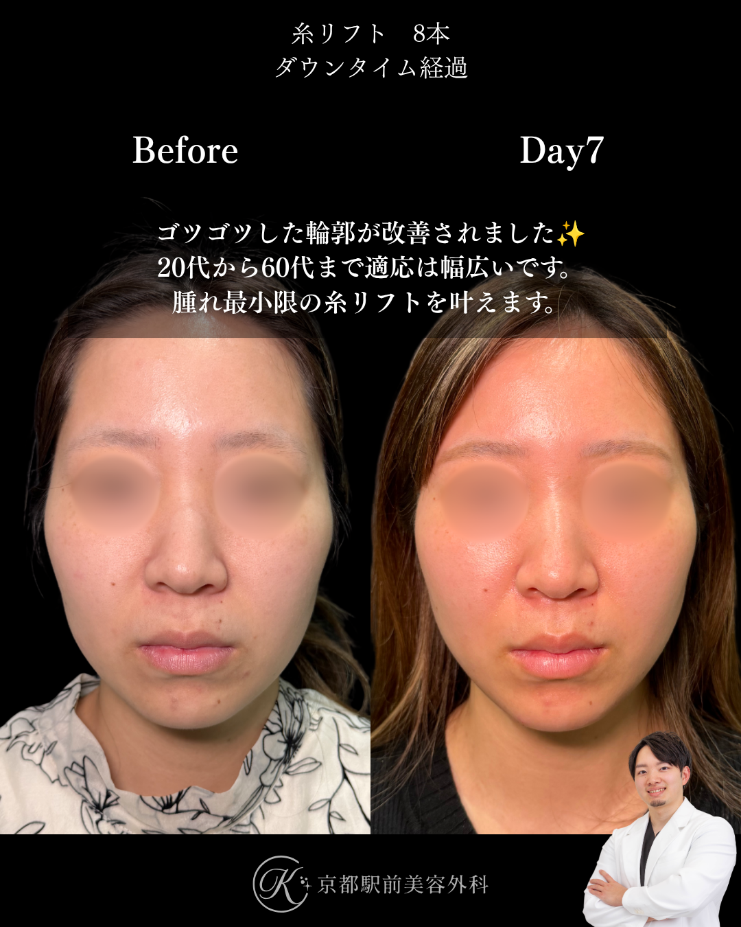 糸リフト1週間の毎日ダウンタイム経過。京都駅前美容外科の医療コラム。京都・大阪で糸リフトなら京都駅前美容外科。