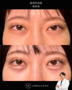 切らない涙袋形成術の術直後経過。(京都駅前美容外科の症例写真)当院は滋賀、京都、大阪をはじめとした関西圏や全国から患者様にお越しいただいています。