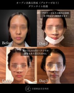 鼻整形の毎日ダウンタイム経過(オープン法鼻尖形成・耳軟骨移植・プロテーゼ)。京都駅前美容外科の医療コラム。京都・大阪で鼻整形なら京都駅前美容外科。