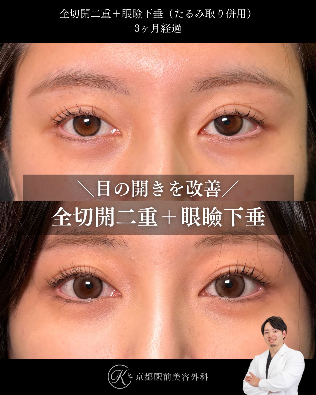 目の開きも改善する、たるみ取り併用全切開二重術＋眼瞼下垂の症例。京都駅前美容外科の症例画像。当院は滋賀、京都、大阪をはじめとした関西圏や全国から患者様にお越しいただいています。