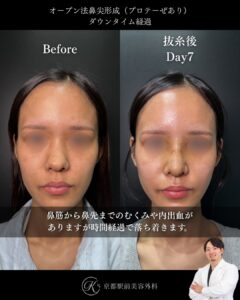 鼻整形の毎日ダウンタイム経過(オープン法鼻尖形成・耳軟骨移植・プロテーゼ)。京都駅前美容外科の医療コラム。京都・大阪で鼻整形なら京都駅前美容外科。