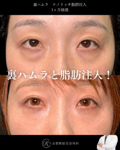 色クマも治す裏ハムラとナノリッチ脂肪注入の症例。京都駅前美容外科の症例画像。当院は滋賀、京都、大阪をはじめとした関西圏や全国から患者様にお越しいただいています。