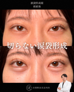 切らない涙袋形成術の術直後経過。(京都駅前美容外科の症例写真)当院は滋賀、京都、大阪をはじめとした関西圏や全国から患者様にお越しいただいています。
