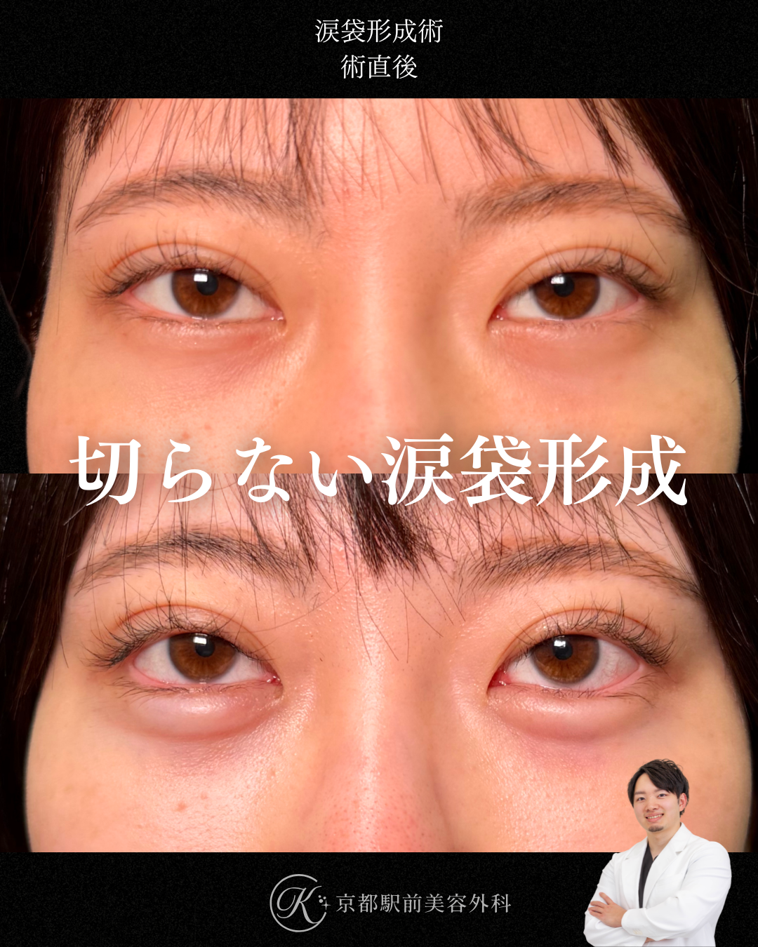 切らない涙袋形成術の術直後経過。（京都駅前美容外科の症例写真）当院は滋賀、京都、大阪をはじめとした関西圏や全国から患者様にお越しいただいています。