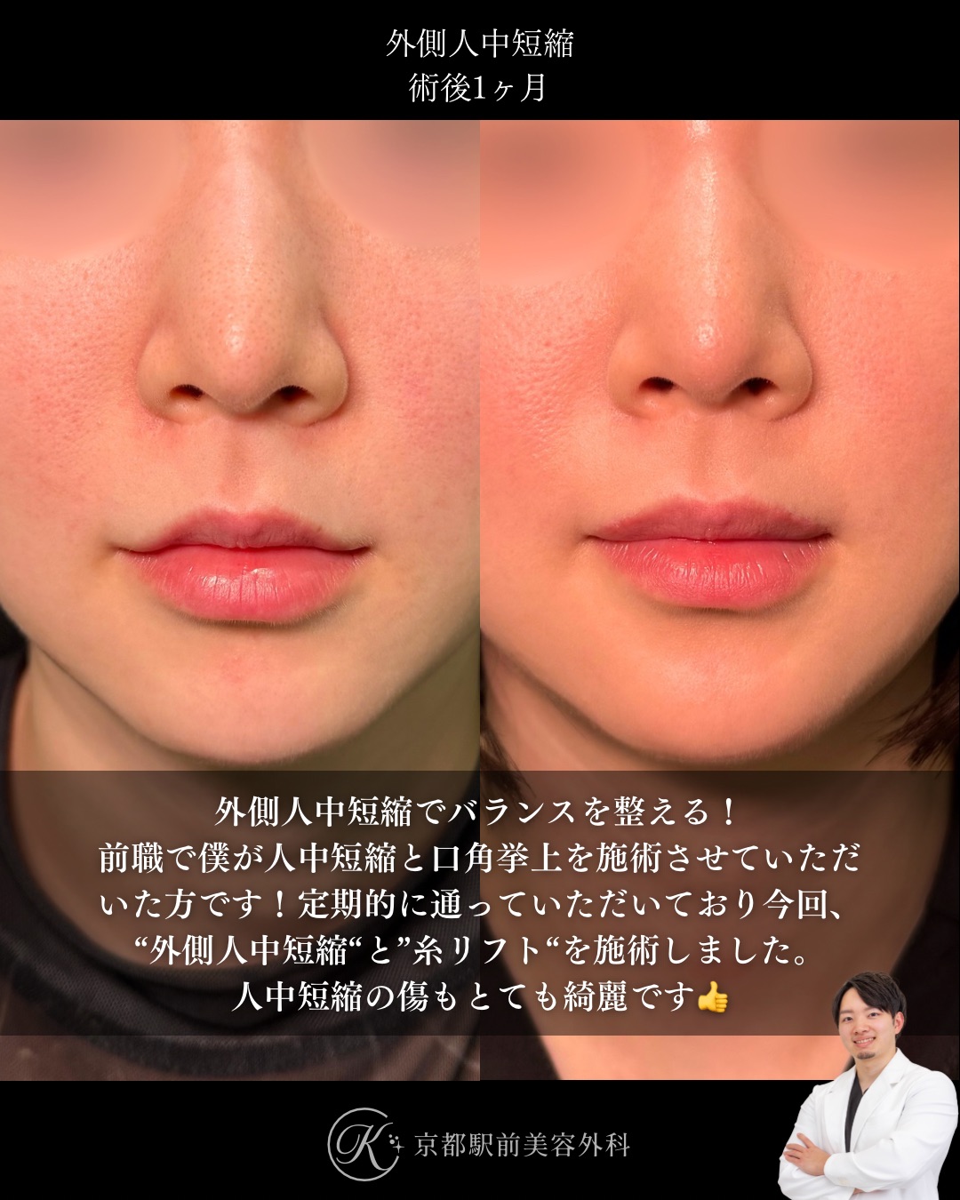 外側人中短縮の術後経過。（京都駅前美容外科の症例）当院は滋賀、京都、大阪をはじめとした関西圏や全国から患者様にお越しいただいています。