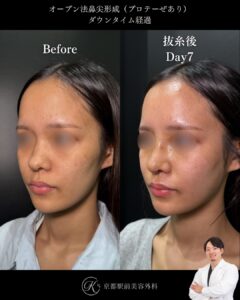 鼻整形の毎日ダウンタイム経過(オープン法鼻尖形成・耳軟骨移植・プロテーゼ)。京都駅前美容外科の医療コラム。京都・大阪で鼻整形なら京都駅前美容外科。