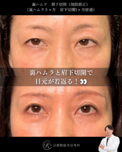 裏ハムラと眉下切開（他院修正）の症例。京都駅前美容外科の症例画像。当院は滋賀、京都、大阪をはじめとした関西圏や全国から患者様にお越しいただいています。