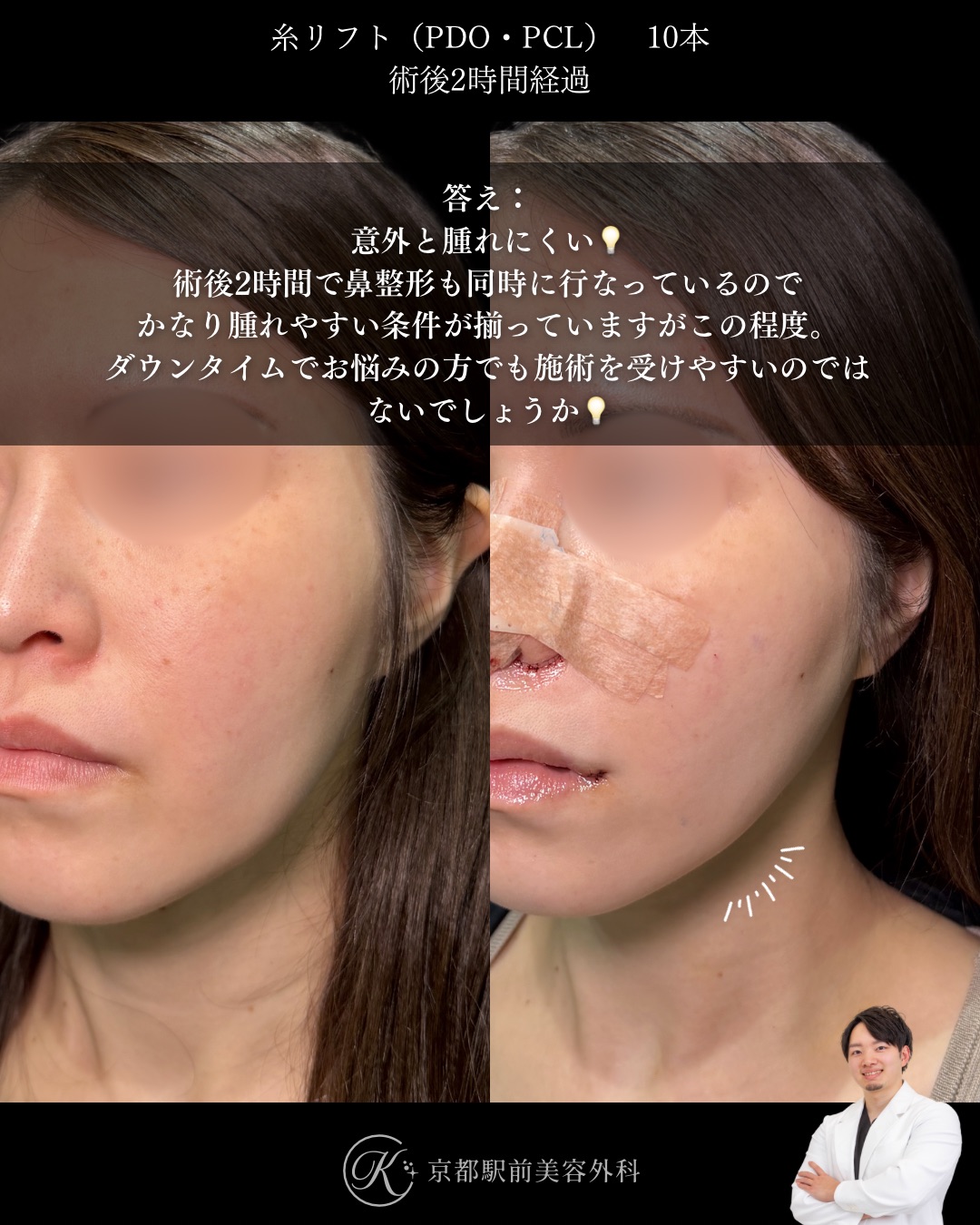 糸リフトって術後は結構腫れる？京都駅前美容外科の術直後写真。京都・大阪で糸リフトなら京都駅前美容外科。