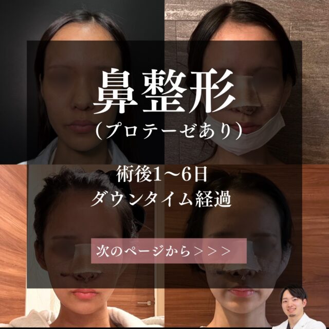 鼻整形の毎日ダウンタイム経過（オープン法鼻尖形成・耳軟骨移植・プロテーゼ）。京都駅前美容外科の医療コラム。京都・大阪で鼻整形なら京都駅前美容外科。