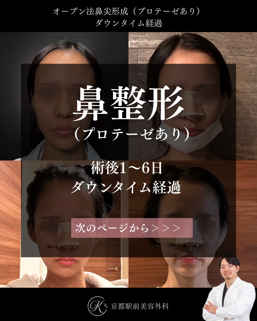 鼻整形の毎日ダウンタイム経過(オープン法鼻尖形成・耳軟骨移植・プロテーゼ)。京都駅前美容外科の医療コラム。京都・大阪で鼻整形なら京都駅前美容外科。