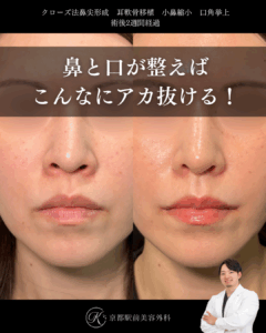 鼻と口が整うとこんなに垢抜ける!クローズ法の鼻尖形成、耳軟骨移植、小鼻縮小内外側法、口角挙上の症例(京都駅前美容外科の症例写真)当院は滋賀、京都、大阪をはじめとした関西圏や全国から患者様にお越しいただいています。
