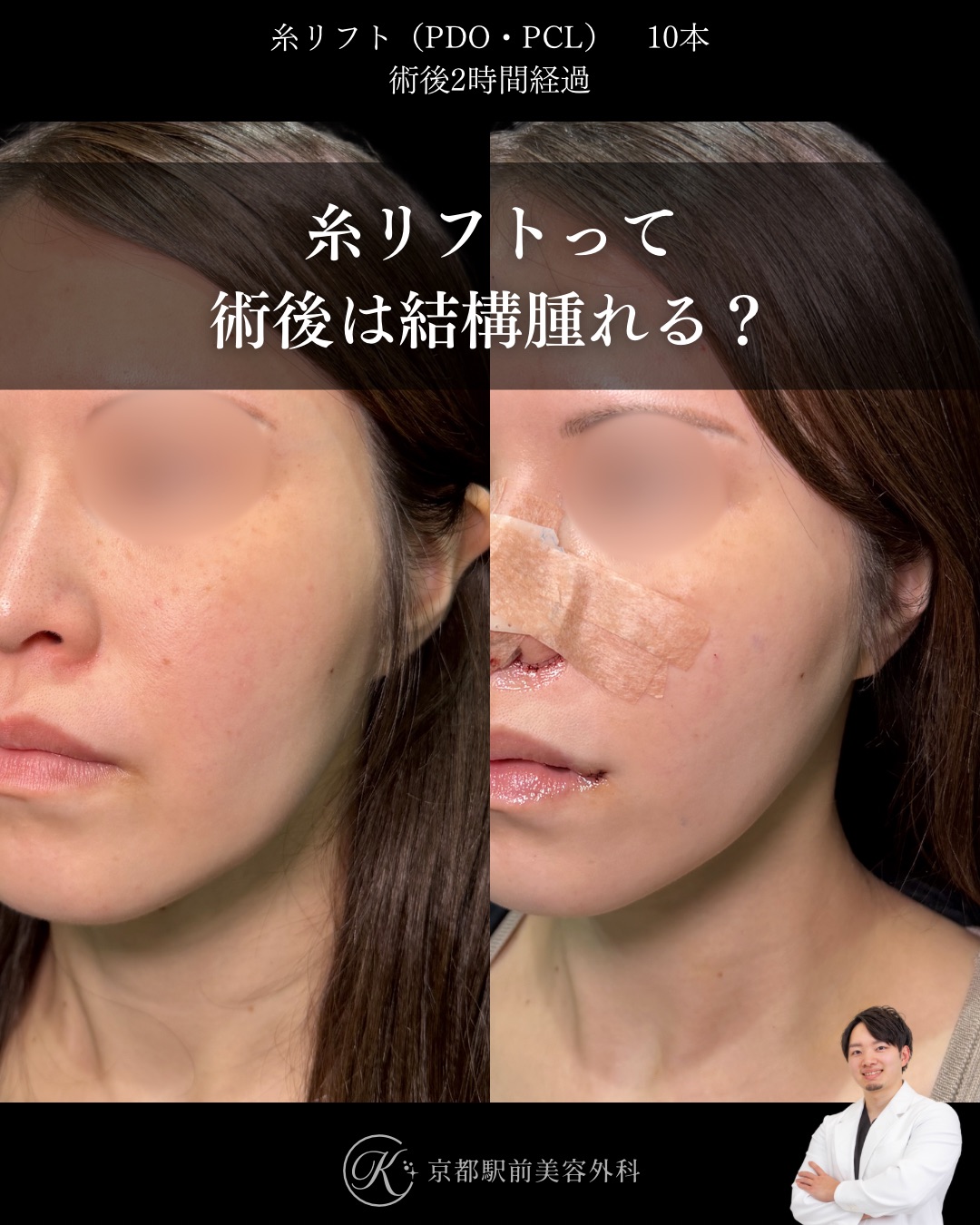 糸リフトって術後は結構腫れる？京都駅前美容外科の術直後写真。京都・大阪で糸リフトなら京都駅前美容外科。
