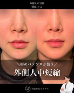 外側人中短縮の術後経過。(京都駅前美容外科の症例)当院は滋賀、京都、大阪をはじめとした関西圏や全国から患者様にお越しいただいています。
