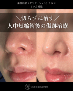 傷跡治療・傷跡修正(グラデーション治療)の症例画像。人中短縮と小鼻縮小によりできた傷跡の写真など(京都駅前美容外科の症例写真)当院は滋賀、京都、大阪をはじめとした関西圏や全国から患者様にお越しいただいています。