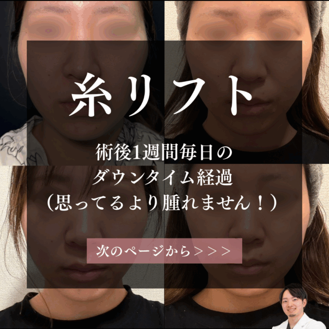 糸リフト1週間の毎日ダウンタイム経過。京都駅前美容外科の医療コラム。京都・大阪で糸リフトなら京都駅前美容外科。