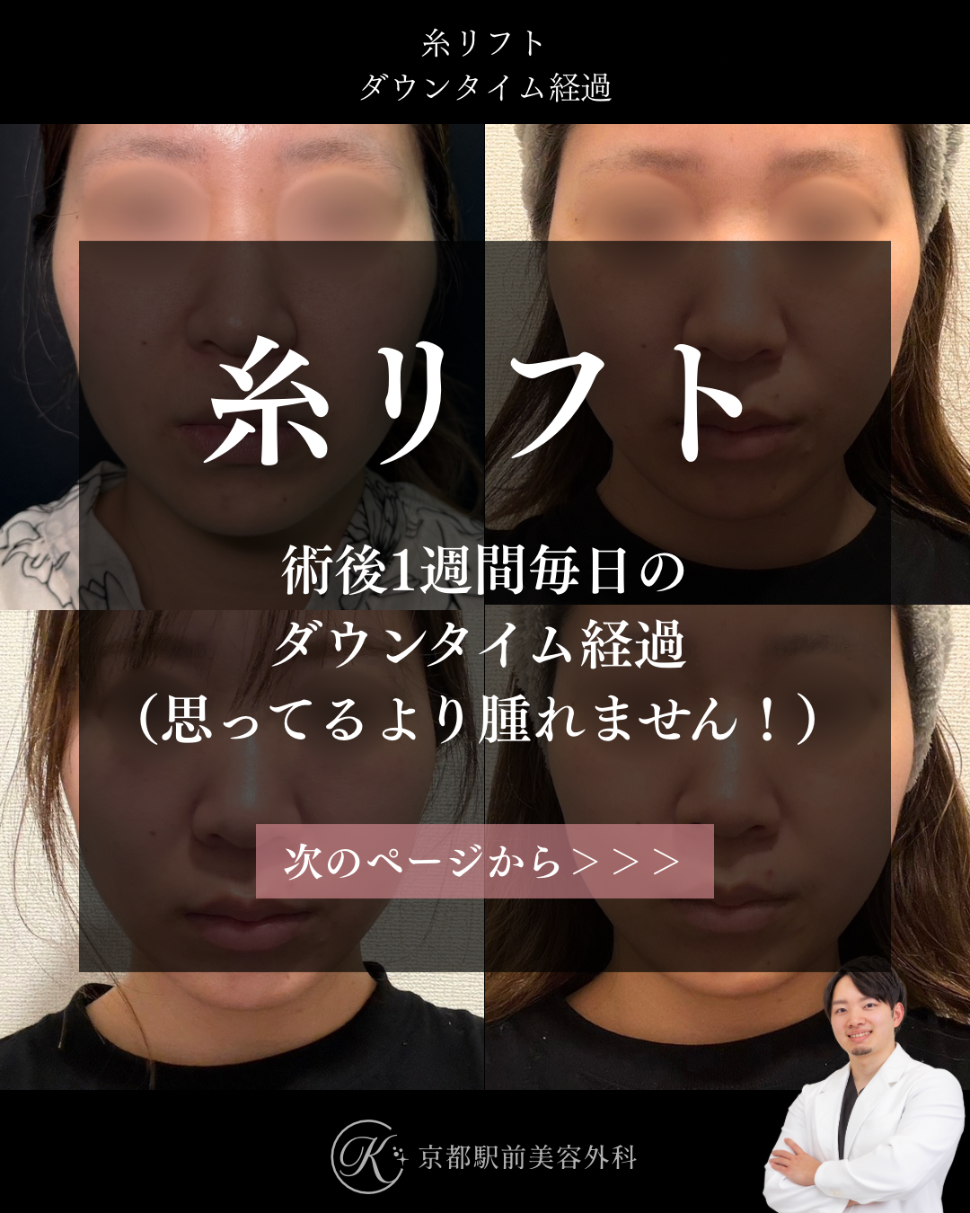 糸リフト1週間の毎日ダウンタイム経過。京都駅前美容外科の医療コラム。京都・大阪で糸リフトなら京都駅前美容外科。