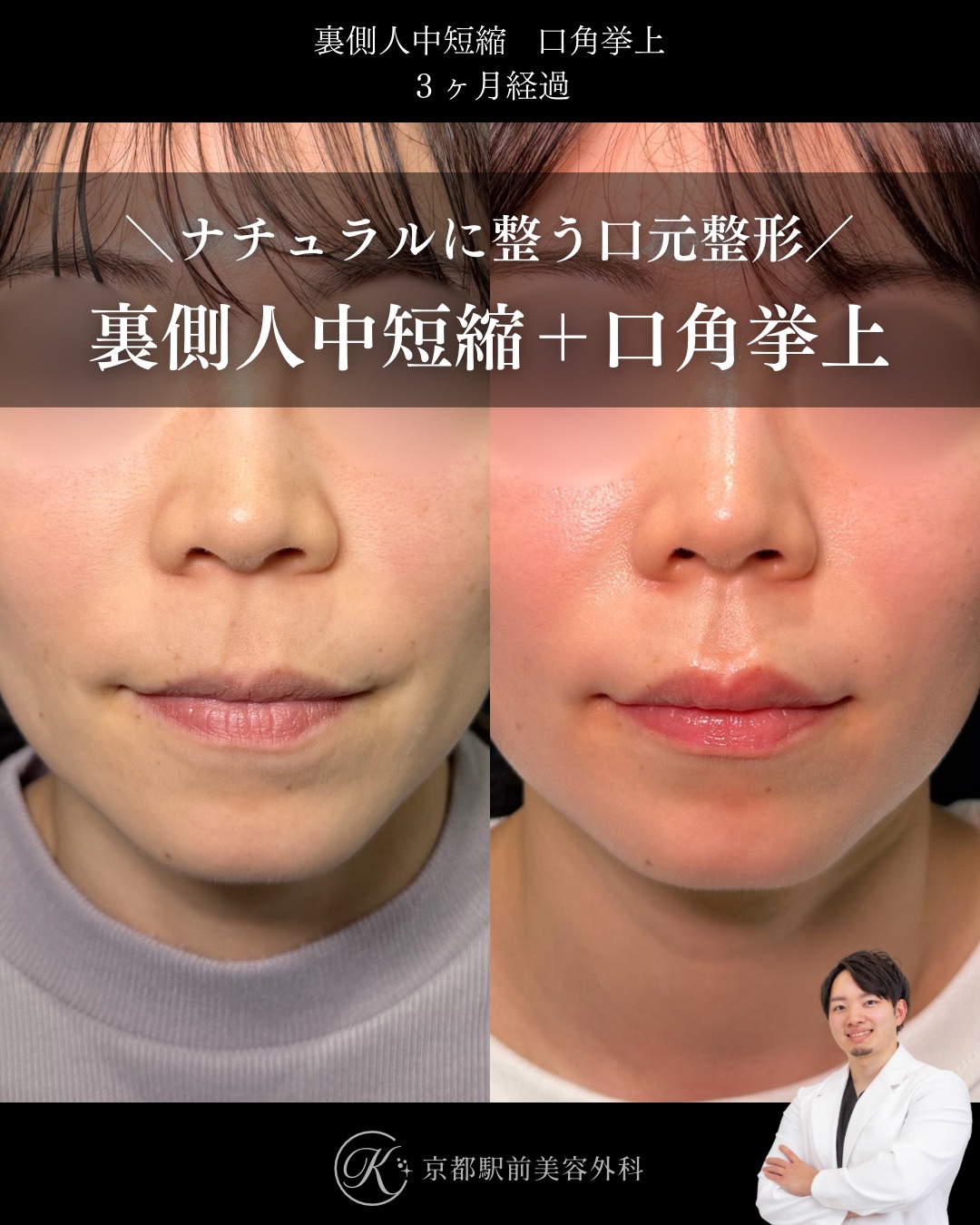 裏側人中短縮、口角挙上（全層法）の症例（京都駅前美容外科の症例写真）当院は滋賀、京都、大阪をはじめとした関西圏や全国から患者様にお越しいただいています。