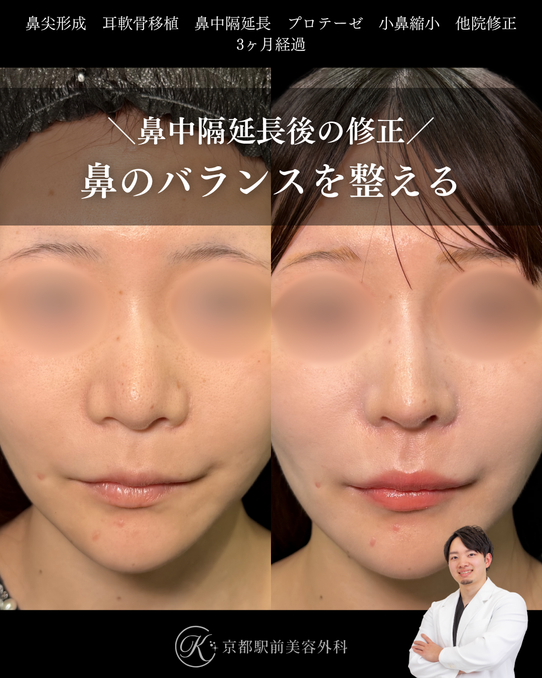 鼻のバランスを整えて骨切りと他院鼻中隔延長術後の低くなった鼻を美しく戻す。鼻尖形成、耳軟骨移植、鼻中隔延長、プロテーゼ、小鼻縮小、他院修正など（京都駅前美容外科の症例）当院は滋賀、京都、大阪をはじめとした関西圏や全国から患者様にお越しいただいています。