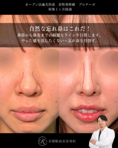 自然な忘れ鼻はこれだ。鼻尖形成、耳軟骨移植、プロテーゼの症例。（京都駅前美容外科の症例）当院は滋賀、京都、大阪をはじめとした関西圏や全国から患者様にお越しいただいています。