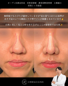 忘れ鼻を作る。鼻尖形成、耳軟骨移植、小鼻縮小の症例。（京都駅前美容外科の症例）当院は滋賀、京都、大阪をはじめとした関西圏や全国から患者様にお越しいただいています。