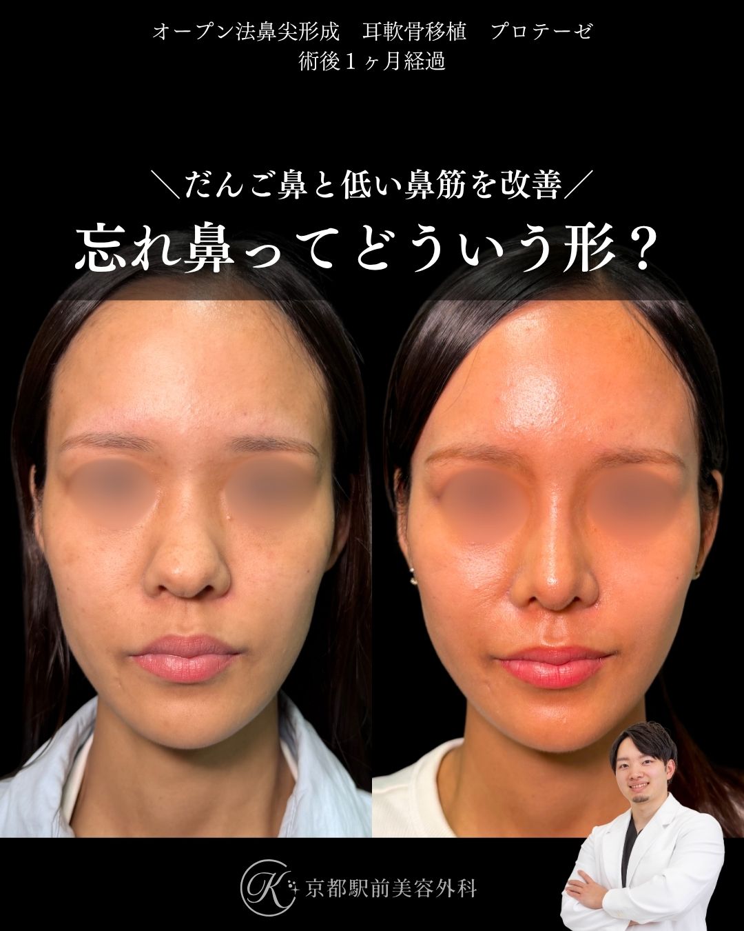 自然な忘れ鼻はこれ。鼻尖形成、耳軟骨移植、プロテーゼの症例。(京都駅前美容外科の症例)当院は滋賀、京都、大阪をはじめとした関西圏や全国から患者様にお越しいただいています。