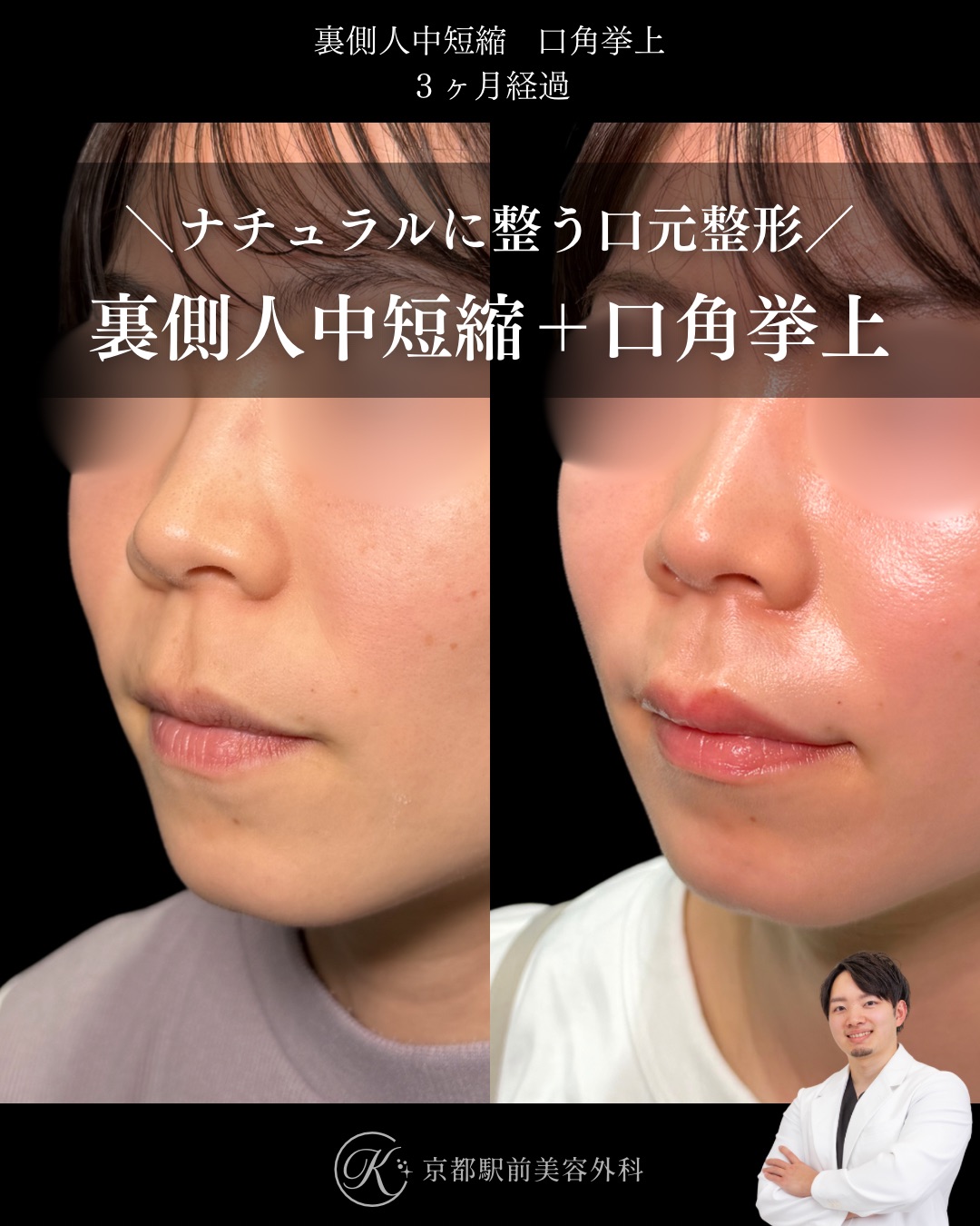 裏側人中短縮、口角挙上(全層法)の症例(京都駅前美容外科の症例写真)当院は滋賀、京都、大阪をはじめとした関西圏や全国から患者様にお越しいただいています。