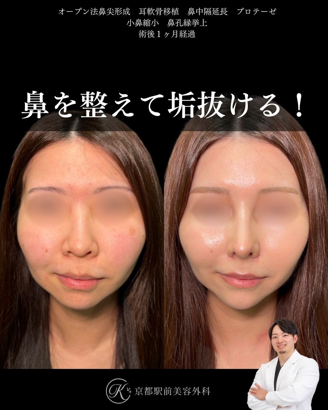 鼻を整えて垢抜ける。鼻尖形成、耳軟骨移植、鼻中隔延長、プロテーゼ、小鼻縮小、鼻孔縁挙上など(京都駅前美容外科の症例)当院は滋賀、京都、大阪をはじめとした関西圏や全国から患者様にお越しいただいています。