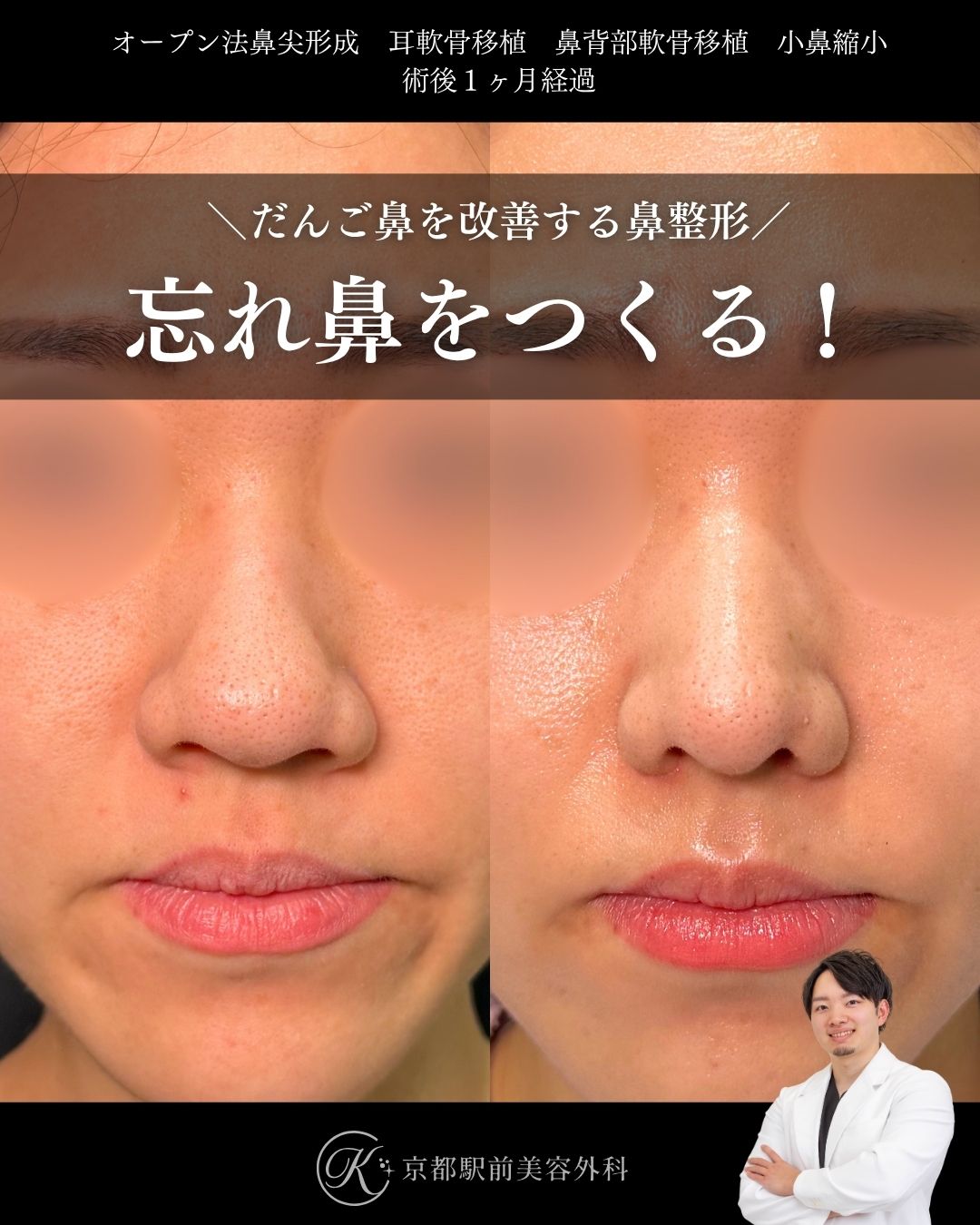 自然な忘れ鼻はこれ。鼻尖形成、耳軟骨移植、プロテーゼの症例。(京都駅前美容外科の症例)当院は滋賀、京都、大阪をはじめとした関西圏や全国から患者様にお越しいただいています。