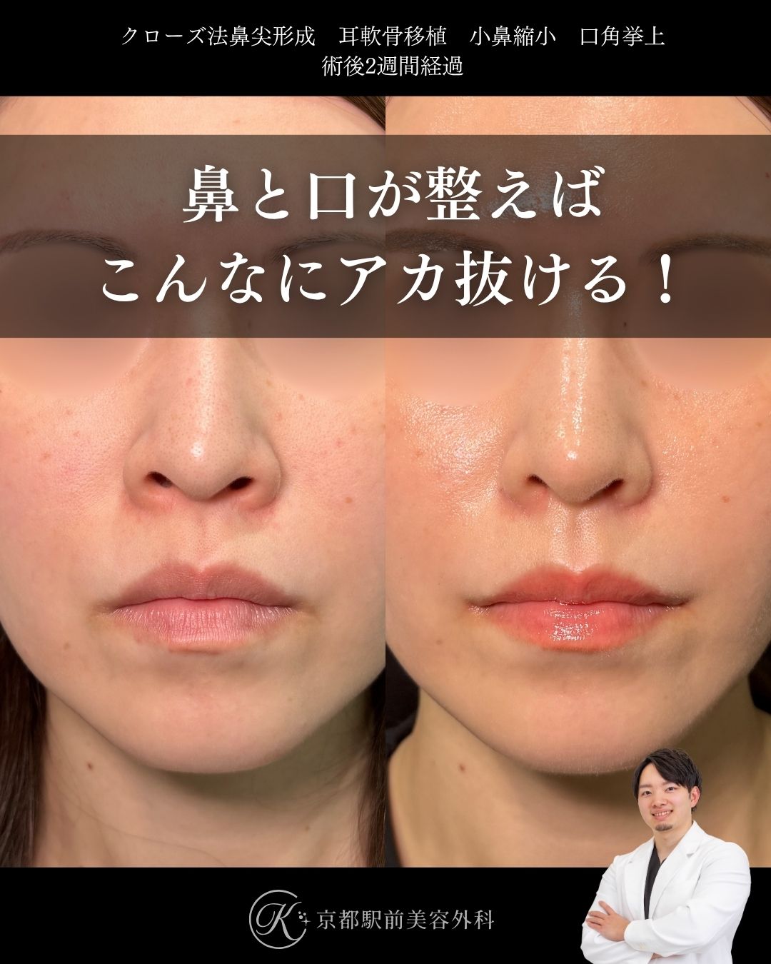 鼻と口が整うとこんなに垢抜ける!クローズ法の鼻尖形成、耳軟骨移植、小鼻縮小内外側法、口角挙上の症例(京都駅前美容外科の症例写真)当院は滋賀、京都、大阪をはじめとした関西圏や全国から患者様にお越しいただいています。
