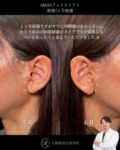 30代のSMASフェイスリフト。京都駅前美容外科の症例写真。当院は滋賀、京都、大阪をはじめとした関西圏や全国から患者様にお越しいただいています。