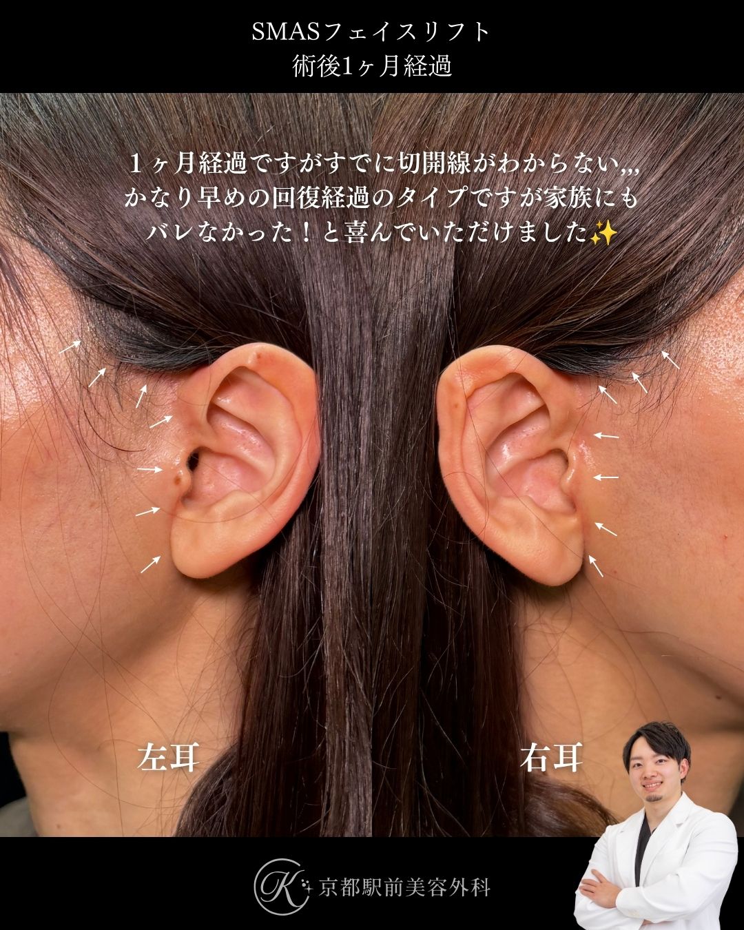 30代のSMASフェイスリフト。京都駅前美容外科の症例写真。当院は滋賀、京都、大阪をはじめとした関西圏や全国から患者様にお越しいただいています。