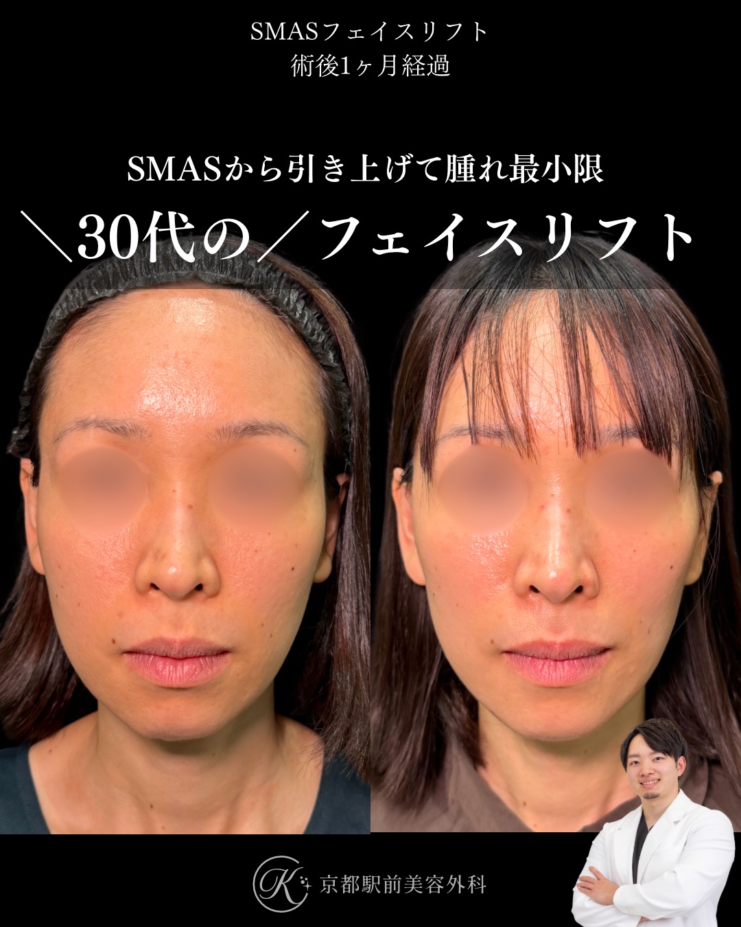 30代のSMASフェイスリフト。京都駅前美容外科の症例写真。当院は滋賀、京都、大阪をはじめとした関西圏や全国から患者様にお越しいただいています。