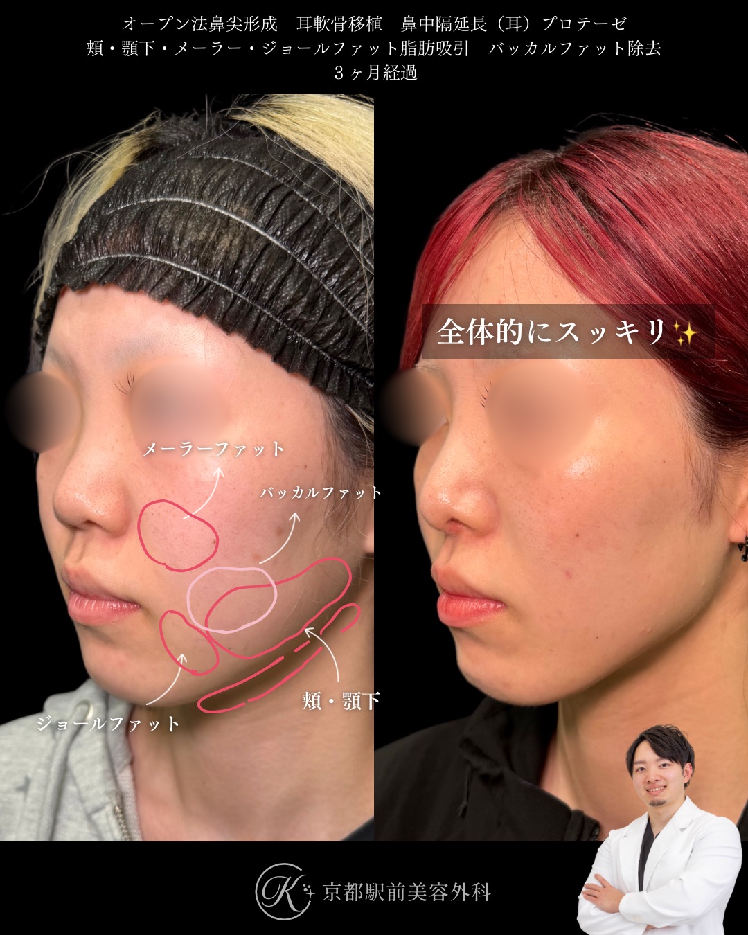 鼻整形と顔の脂肪吸引！鼻尖形成、耳軟骨移植、鼻中隔延長、頬顎下脂肪吸引、メーラーファット、ジョールファット除去、バッカルファット除去の京都駅前美容外科の症例写真。当院は滋賀、京都、大阪をはじめとした関西圏や全国から患者様にお越しいただいています。